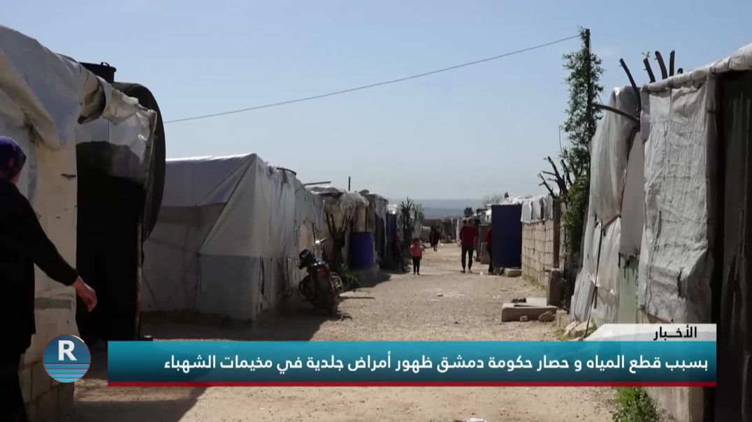 بسبب قطع المياه و حصار حكومة دمشق ظهور أمراض جلدية في مخيمات الشهباء