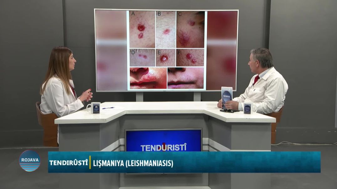 Mijar: LIŞMANIYA (LEISHMANIASIS) TENDIRUSTÎ 26-12-2024